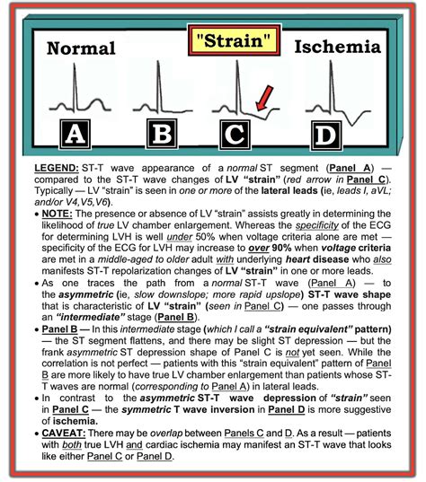 lv strain ecg|my LVHN sign in.